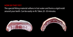 thermoplastic teeth fitting